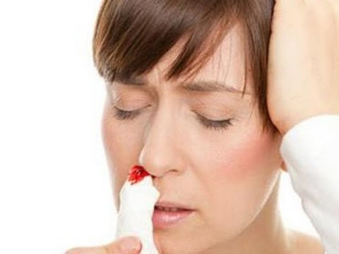 Bị chảy máu mũi nhiều là do bệnh gì?