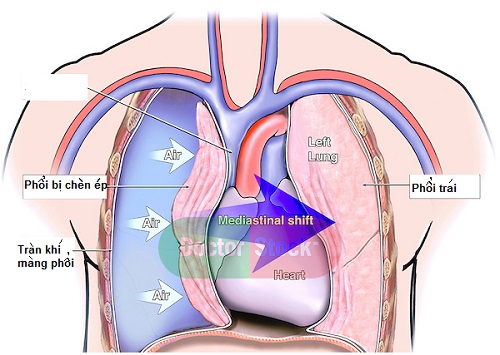 Bị tràn khí màng phổi có phải mổ không?